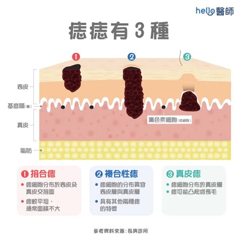 身體長痣的原因|痣變大、痣多或長毛會變皮膚癌？認識痣的形成與原因